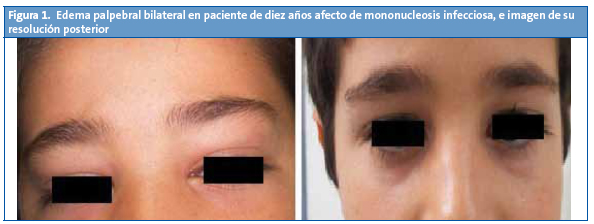 Figura 1. Edema palpebral bilateral en paciente de diez años afecto de mononucleosis infecciosa, e imagen de su resolución posterior