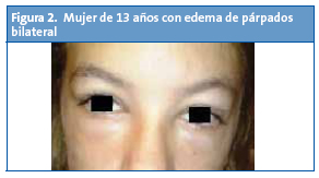 Figura 2. Mujer de 13 años con edema de párpados bilateral