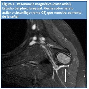 Figura 3. Resonancia magnética (corte axial). Estudio del plexo braquial. Flecha sobre nervio axilar o circunflejo (rama C5) que muestra aumento de la señal