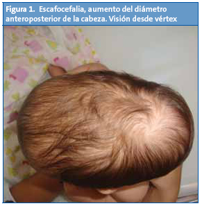 Figura 1. Escafocefalia, aumento del diámetro anteroposterior de la cabeza. Visión desde vértex