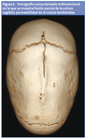 Figura 2. Tomografía computarizada tridimensional en la que se muestra fusión parcial de la sutura sagital y permeabilidad de la sutura lambdoidea