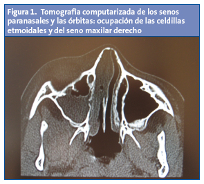 Figura 1. Tomografía computarizada de los senos paranasales y las órbitas: ocupación de las celdillas etmoidales y del seno maxilar derecho.