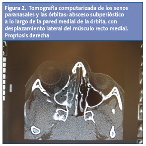 Figura 2. Tomografía computarizada de los senos paranasales y las órbitas: absceso subperióstico a lo largo de la pared medial de la órbita, con desplazamiento lateral del músculo recto medial. Proptosis derecha.