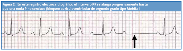 Figura 2. En este registro electrocardiográfico el intervalo PR se alarga progresivamente hasta que una onda P no conduce (bloqueo auriculoventricular de segundo grado tipo Mobitz I