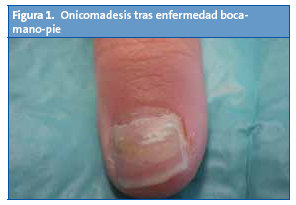 Figura 1. Onicomadesis tras enfermedad bocamano- pie