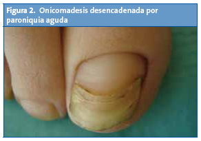 Figura 2. Onicomadesis desencadenada por paroniquia aguda
