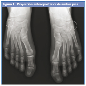 Figura 1. Proyección anteroposterior de ambos pies