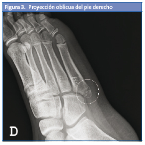 Figura 3. Proyección oblicua del pie derecho