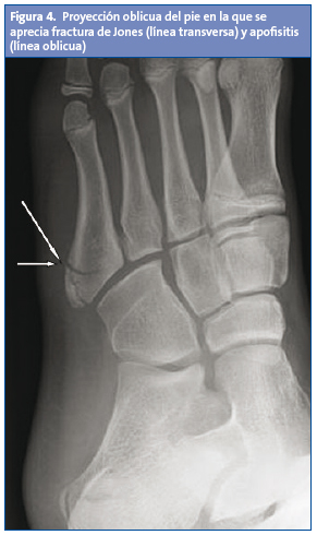 Figura 4. Proyección oblicua del pie en la que se aprecia fractura de Jones (línea transversa) y apofisitis (línea oblicua)