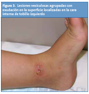 Figura 3. Lesiones vesiculosas agrupadas con exudación en la superficie localizadas en la cara interna de tobillo izquierdo