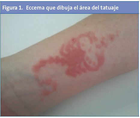 Figura 1. Eccema que dibuja el área del tatuaje