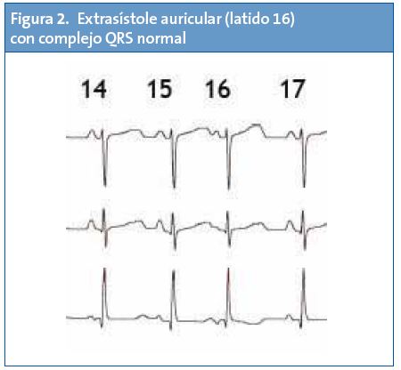 Figura 2. Extrasístole auricular (latido 16) con complejo QRS normal