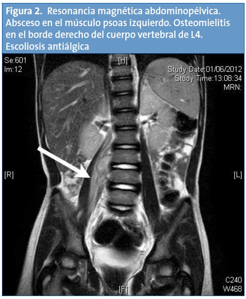 Figura 2. Resonancia magnética abdominopélvica. Absceso en el músculo psoas izquierdo. Osteomielitis en el borde derecho del cuerpo vertebral de L4. Escoliosis antiálgica