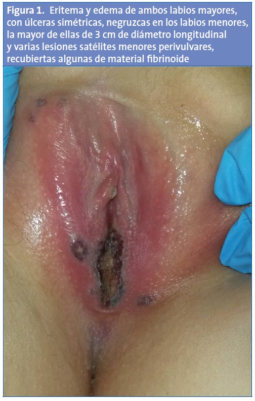 Figura 1. Eritema y edema de ambos labios mayores, con úlceras simétricas, negruzcas en los labios menores, la mayor de ellas de 3 cm de diámetro longitudinal y varias lesiones satélites menores perivulvares, recubiertas algunas de material fibrinoide