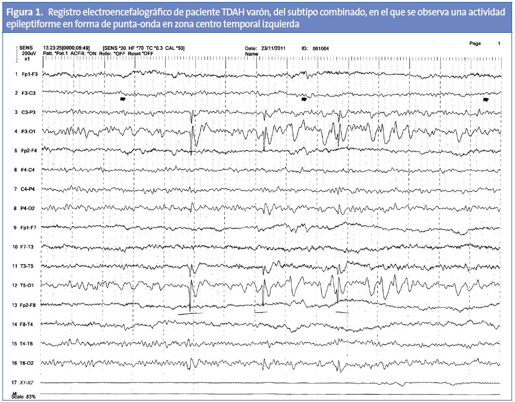 Figura 1. Registro electroencefalográfico de paciente TDAH varón, del subtipo combinado, en el que se observa una actividad epileptiforme en forma de punta-onda en zona centro temporal izquierda