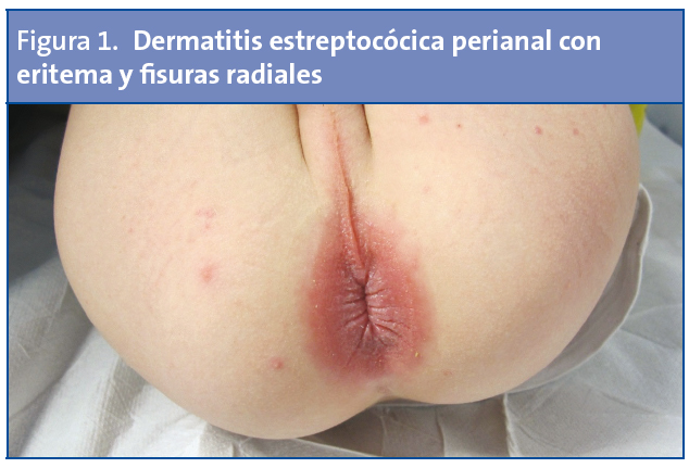 Figura 1. Dermatitis estreptocócica perianal con eritema y fisuras radiales