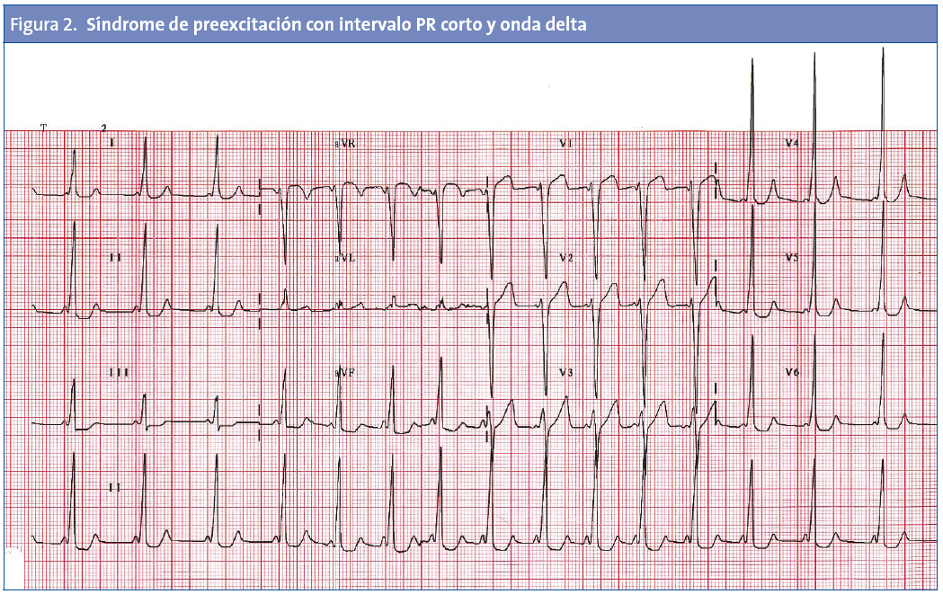 Figura 2. Síndrome de preexcitación con intervalo PR corto y onda delta