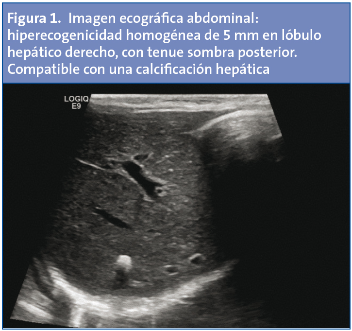 Figura 1. Imagen ecográfica abdominal: hiperecogenicidad homogénea de 5 mm en lóbulo hepático derecho, con tenue sombra posterior. Compatible con una calcificación hepática.