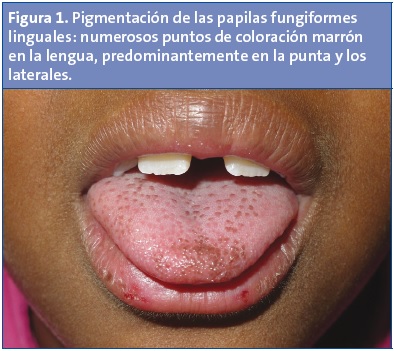 Figura 1. Pigmentación de las papilas fungiformes linguales: numerosos puntos de coloración marrón en la lengua, predominantemente en la punta y los laterales.