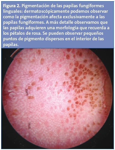Figura 2. Pigmentación de las papilas fungiformes linguales: dermatoscópicamente podemos observar como la pigmentación afecta exclusivamente a las papilas fungiformes. A más detalle observamos que las papilas adquieren una morfología que recuerda a los pétalos de rosa. Se pueden observar pequeños puntos de pigmento dispersos en el interior de las papilas.