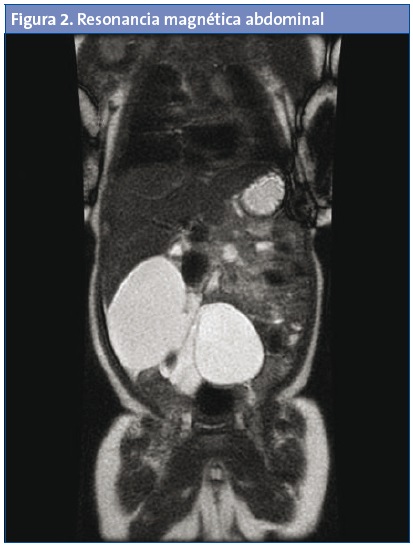 Figura 2. Resonancia magnética abdominal.