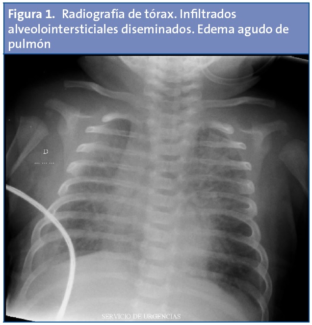 Figura 1. Radiografía de tórax. Infiltrados alveolointersticiales diseminados. Edema agudo de pulmón.