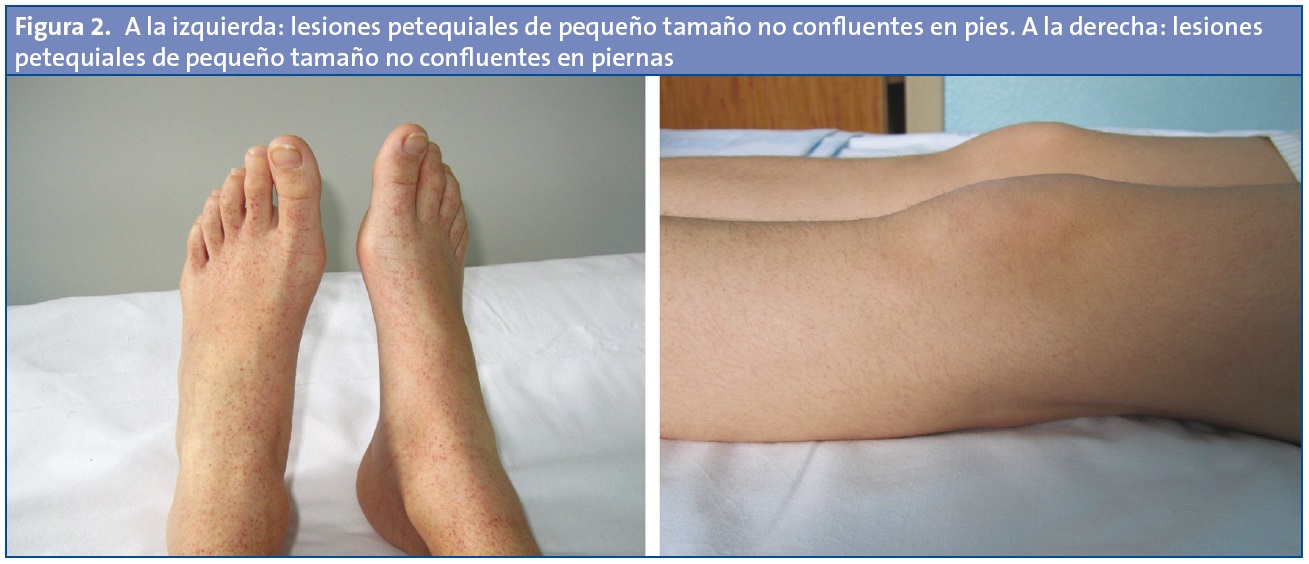 Figura 2. A la izquierda: lesiones petequiales de pequeño tamaño no confluentes en pies. A la derecha: lesiones petequiales de pequeño tamaño no confluentes en piernas.