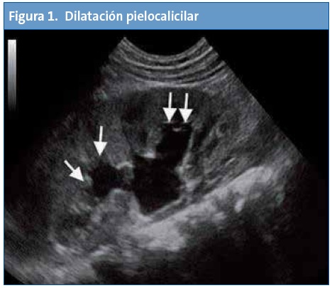 Figura 1. Dilatación pielocalicilar