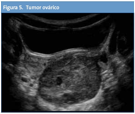 Figura 5. Tumor ovárico