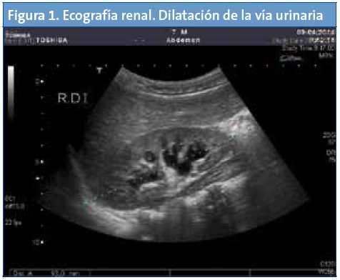 Figura 1. Ecografía renal. Dilatación vía urinaria.
