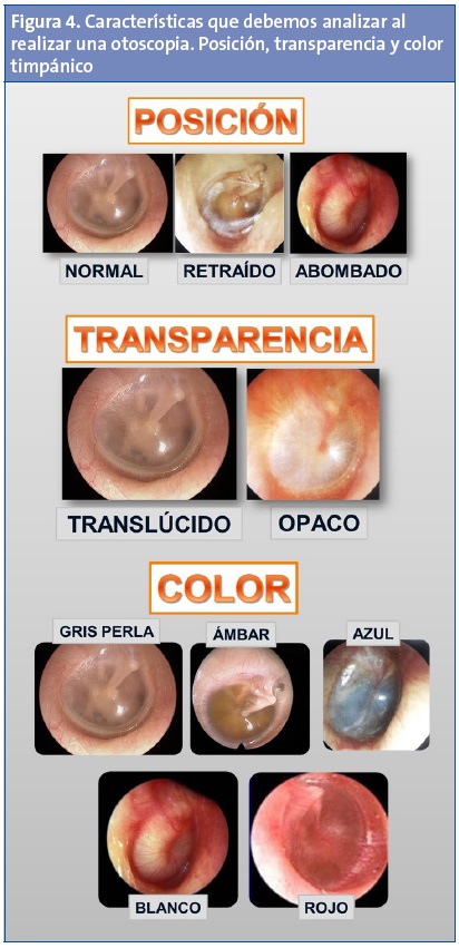 Figura 4. Características que debemos analizar al realizar una otoscopia. Posición, transparencia y color timpánico