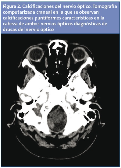 Figura 2. Calcificaciones del nervio óptico. Tomografía computarizada craneal en la que se observan calcificaciones puntiformes características en la cabeza de ambos nervios ópticos diagnósticas de drusas del nervio óptico.