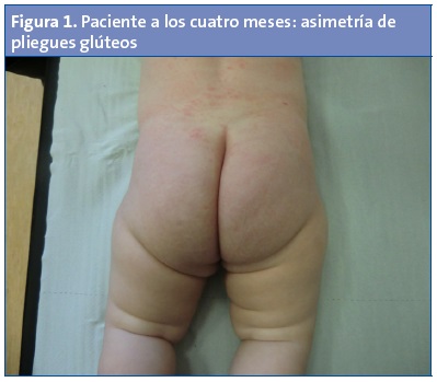Figura 1. Paciente a los cuatro meses: asimetría de pliegues glúteos.