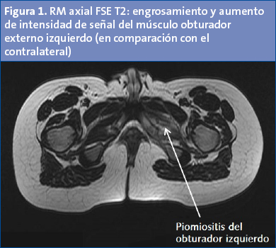 Figura 1. RM axial FSE T2: engrosamiento y aumento de intensidad de señal del músculo obturador externo izquierdo (en comparación con el contralateral)