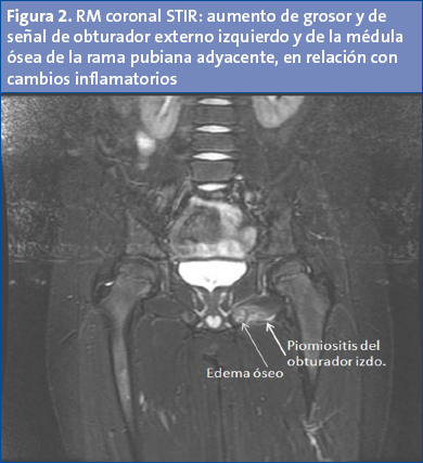 Figura 2. RM coronal STIR: aumento de grosor y de señal de obturador externo izquierdo y de la médula ósea de la rama pubiana adyacente, en relación con cambios inflamatorios