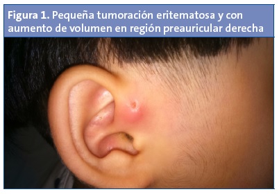 Pequeña tumoración eritematosa y con aumento de volumen en región preauricular derecha.