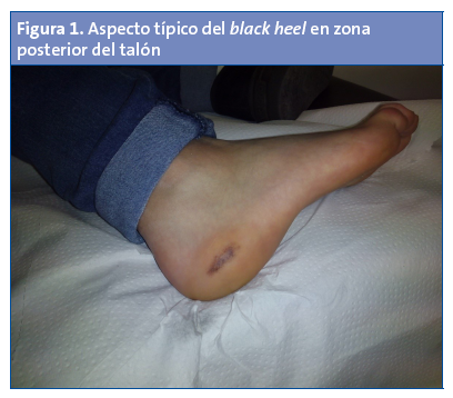 Aspecto típico del <em>black heel</em> en zona posterior del talón.