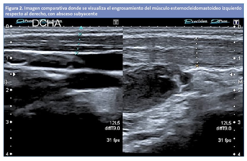 Figura 2. Imagen comparativa donde se visualiza el engrosamiento del músculo esternocleidomastoideo izquierdo respecto al derecho, con absceso subyacente.