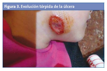 Figura 3. Evolución tórpida de la úlcera