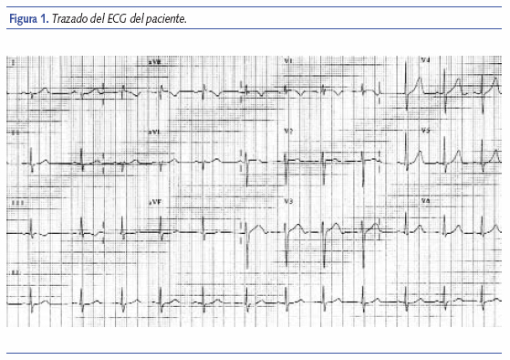 Trazado del ECG del paciente