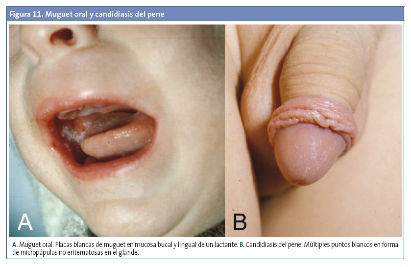 Figura 11. Muguet oral y candidiasis del pene