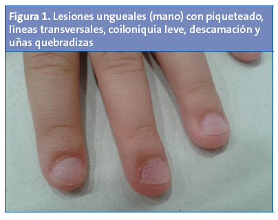 Figura 1. Lesiones ungueales (mano) con piqueteado, líneas transversales, coiloniquia leve, descamación y uñas quebradizas