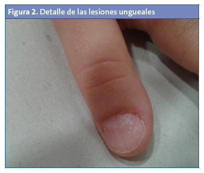 Figura 2. Detalle de las lesiones ungueales