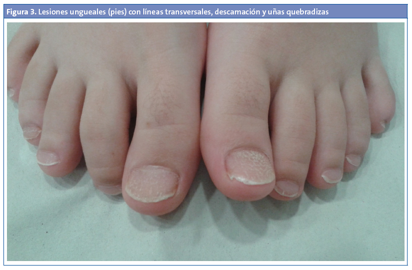Figura 3. Lesiones ungueales (pies) con líneas transversales, descamación y uñas quebradizas