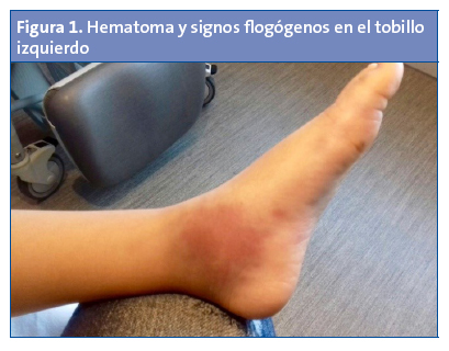 Figura 1. Hematoma y signos flogógenos en el tobillo izquierdo
