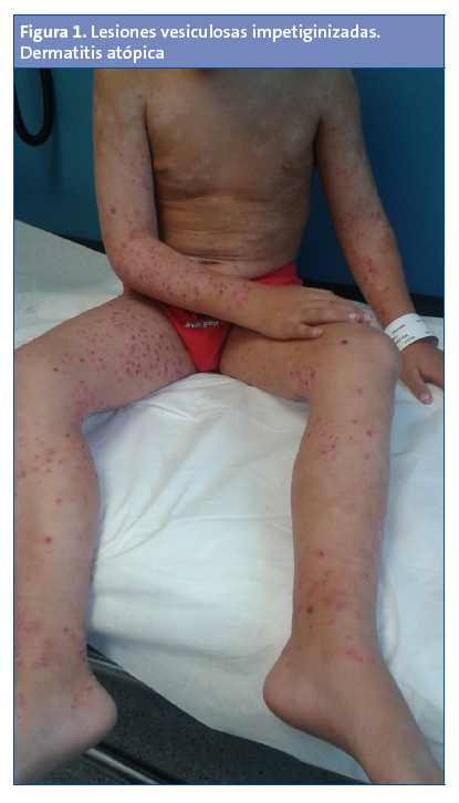 Figura 1. Lesiones vesiculosas impetiginizadas. Dermatitis atópica