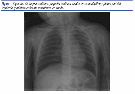 Signo del diafragma continuo, pequeña cantidad de aire entre mediastino y pleura parietal izquierda, y mínimo enfisema subcutáneo en cuello