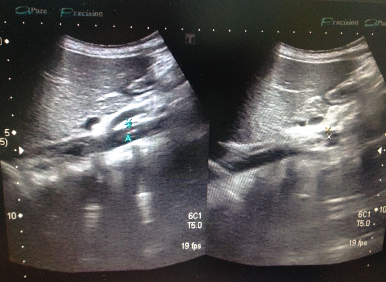 Figura 2. Ecografía renal en el que se observa la estenosis a nivel del paso entre la aorta y la