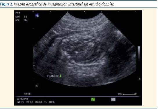Figura 2. Imagen ecográfica de invaginación intestinal sin estudio doppler.