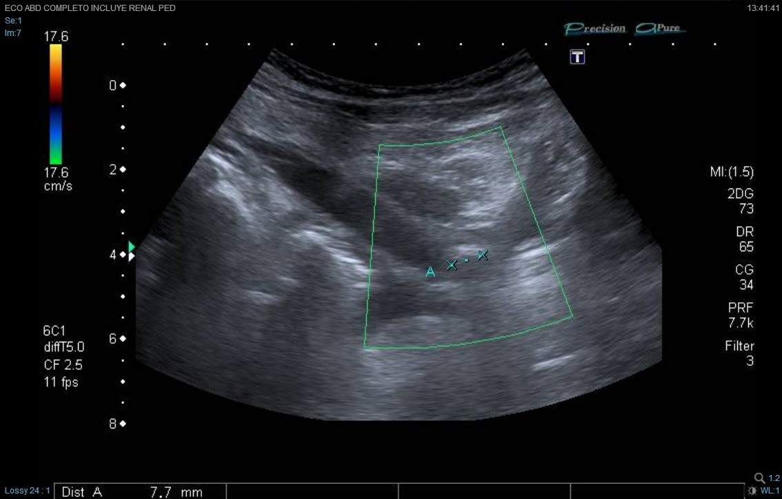 Figura 1. Imagen ecográfica de litiasis ureteral derecha, con sombra sónica posterior